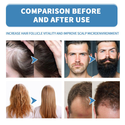 🔥Limited-time 50% off🌿EAST MOON Minoxi Roll-On Hair Treatment